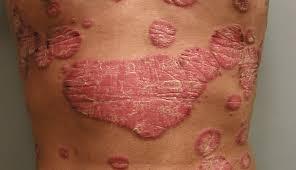 Psoriasis Causes, Triggers, and Treatments: What Is Psoriasis?: National  Psoriasis Foundation